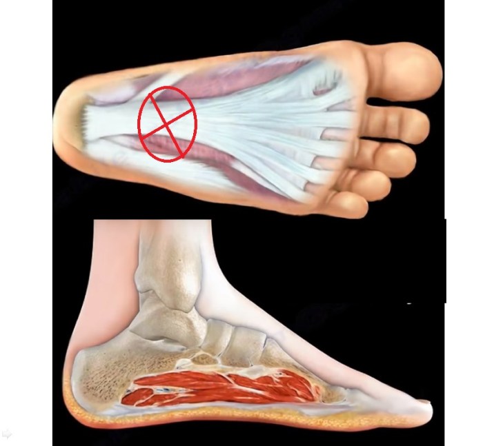 Do i have plantar fasciitis quiz