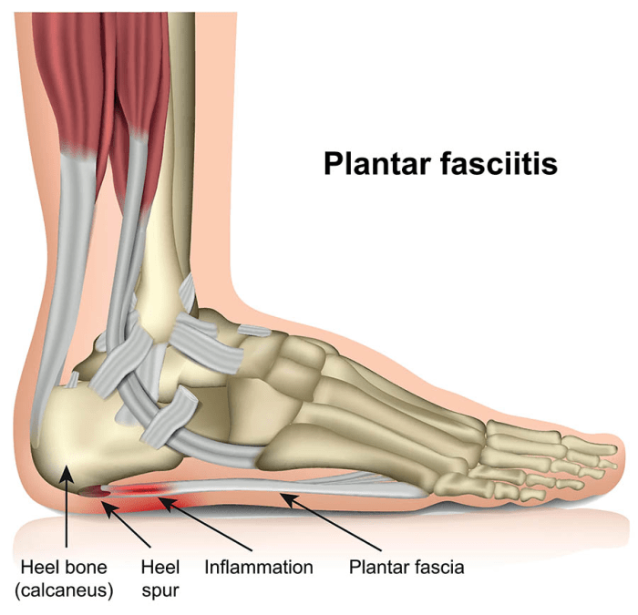 Plantar fasciitis fascia physical offal brad bob exercises